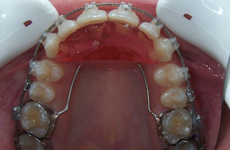 appareil-plaque-surelevation appareil-plaque-surelevation