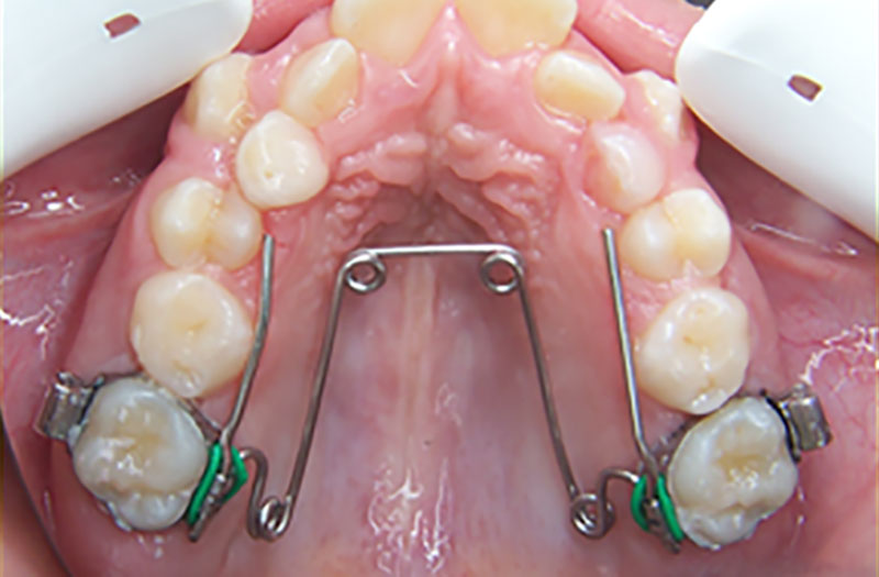 appareil-quad-helix2 appareil-quad-helix2